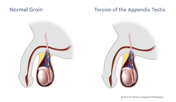 torsion of the appendix illustration