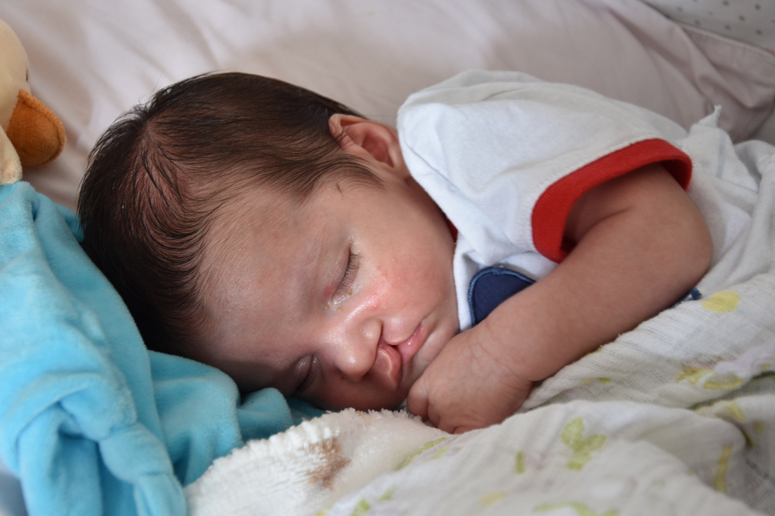 Closeup of a sleeping newborn with a facial disorder
