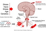 Amplified musculoskeletal pain syndrome (AMPS) brain illustration