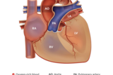 coarctation of the aorta illustration 2
