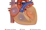 coarctation of the aorta illustration 3