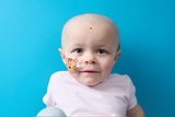 Child with a nasogastric (NG) feeding tube held in place by a child-friendly sticker.