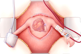 arley procedure illustration. 