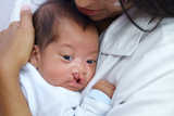 A clinician holding a newborn baby with a facial deformity