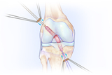 Illustation of a knee graft used to repair a torn ACL