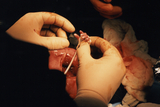 A fetal surgeon holds the tiny hand of Roberto, who was returned to his mother's womb after having a tumor removed in utero