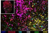 Neuroblastoma image