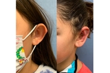 Ear surgery - before and after