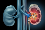 Kidney stones diagram