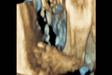 3-D ultrasounds of clubfoot 3-D ultrasounds of clubfoot