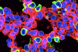 CRISPR-edited lung cells (green) with fluorescent protein. Many, but not all, are alveolar lung cells. CRISPR-edited lung cells