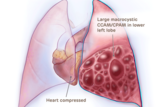 Medical illustration of large macrocystic CCAM/CPAM heart compressed