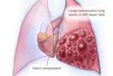 Medical illustration of large macrocystic lung lesion heart compressed