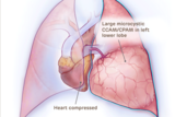 Medical illustration of large microcystic CCAM/CPAM heart compressed