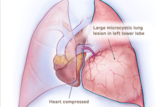 Medical illustration of large microcystic lung lesion, heart compressed
