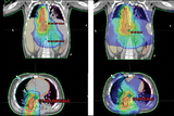 radiation treatment plans