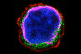 Photograph of an acute lymphoblastic leukemia cell Photograph of an acute lymphoblastic leukemia cell