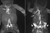 MRIs showing dynamic contrast MR lymphangiography (DCMRL) in neonatal chylothorax and CLFD MRIs showing dynamic contrast MR lymphangiography (DCMRL) in neonatal chylothorax and CLFD