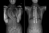 xrays showing idiopathic scoliosis