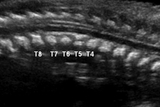 Fetal CT showing sagittal view of single anomalous vertebrae