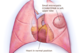 Medical illustration of small microcystic CCAM/CPAM heart not compressed