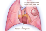 Medical illustration of small microcystic lung lesion, heart not compressed