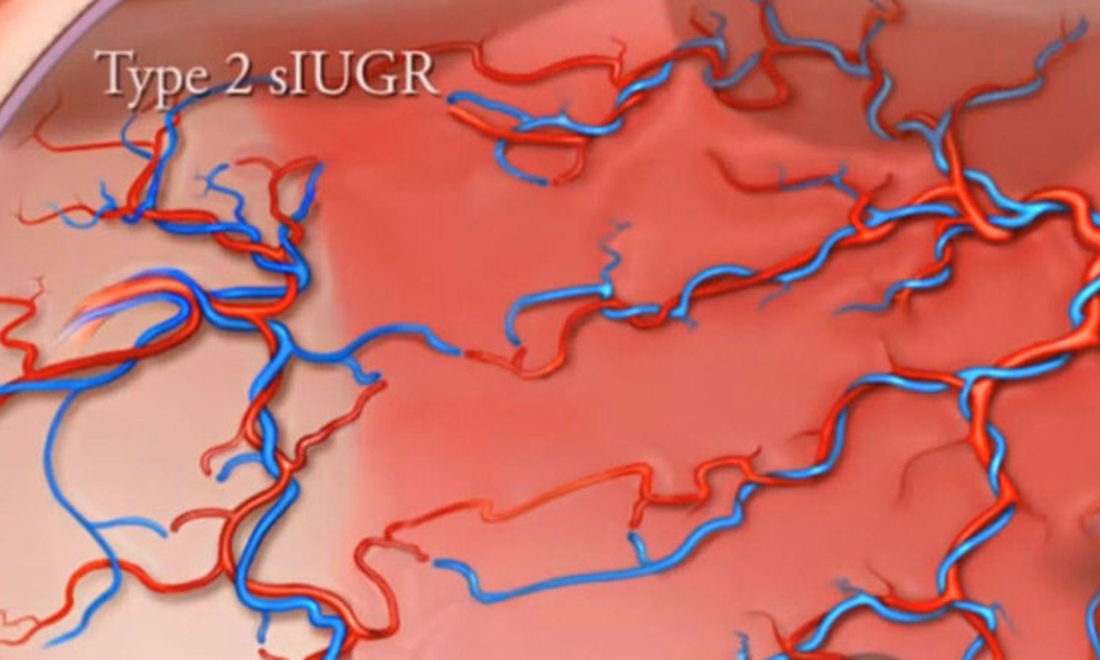 Selective Intrauterine Growth Restriction (sIUGR) Children's Hospital