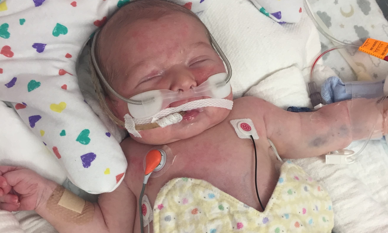 Cameron as a baby after surgery
