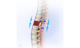 Next, the spine is slowly shortened to close the gap. During this process, the health of the spinal cord is monitored with electrodes.