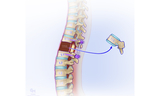 Secondly, Metal rods are placed, connecting the screws above and below. Then the majority of one of the vertebral bodies in between is removed. This is done by carefully working around the spinal cord.