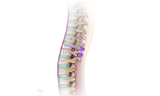 With the spine now shortened, the rods are switched out for shorter, permanent rods and everything is locked in place.