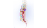 A view inside the spinal column shows the spinal cord and nerve roots are no longer under tension.
