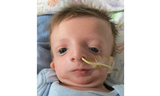 male baby with Treacher Collins syndrome
