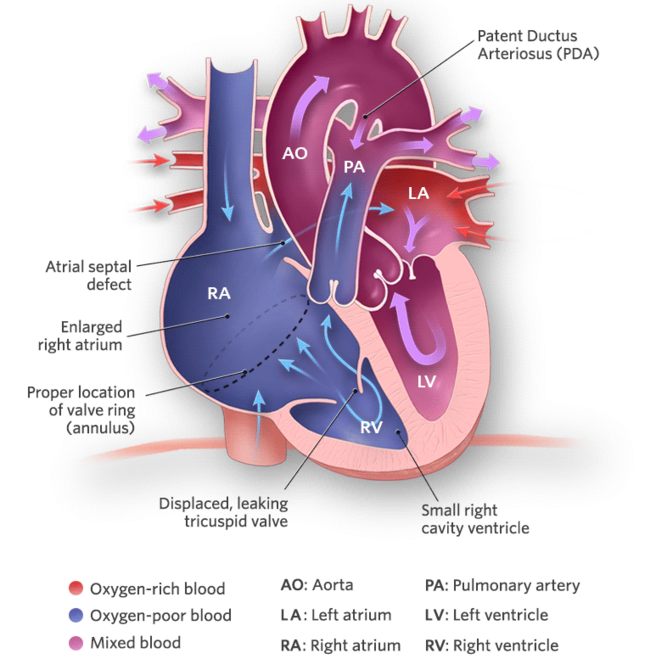 Ebstein’s anomaly of the tricuspid valve illustration