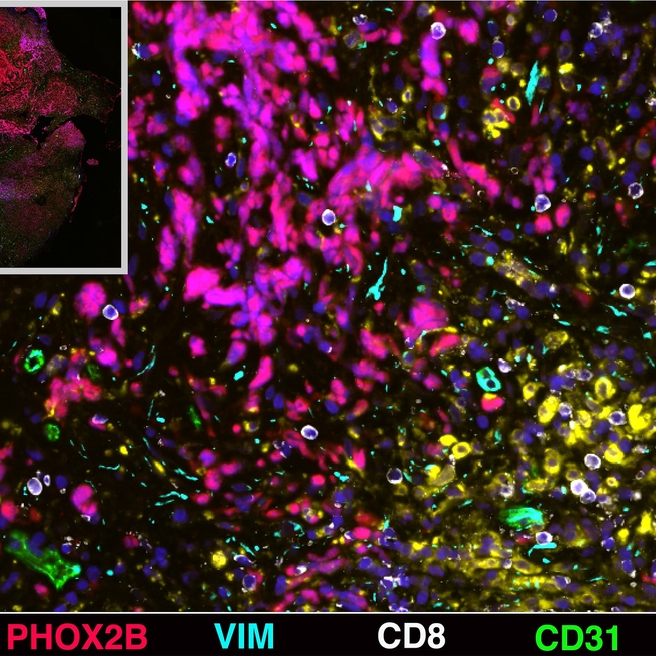 Neuroblastoma image