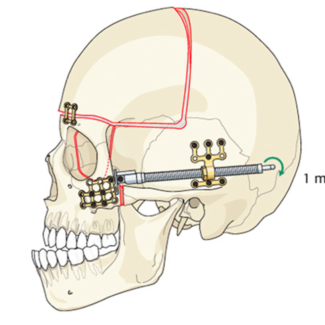 Surgical Management of Craniofacial Conditions | Children&rsquo;s 