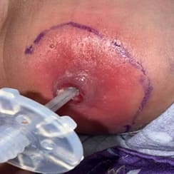 Erythema around Stoma