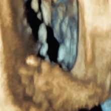 3-D ultrasound of clubfoot