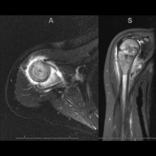 X-Ray of Arkader Limb Tumor