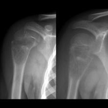 X-ray of Arkader Limb Tumor