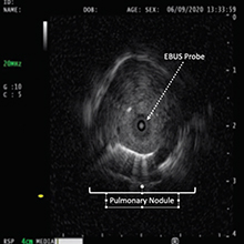 Radial EBUS image