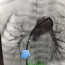 Angiographic image of the pulmonary artery immediately following deployment of the vascular occlude device.