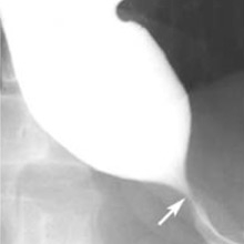 barium swallow image