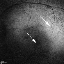 hypoautofluorescent areas of boy's left eye