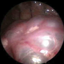 thoracoscopic view of ccam