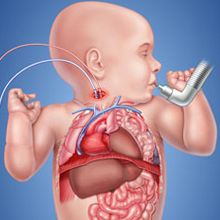 cdh child on ecmo illustration