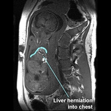 MRI of CDH Congenital Diaphragmatic Hernia