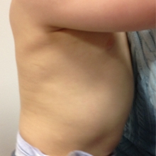 chest appearance one year after lobectomy