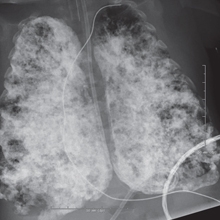 Chest X-ray of an infant with severe CLD