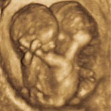conjoined twins 3D ultrasound